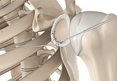 Arthroscopic Bankart Repair