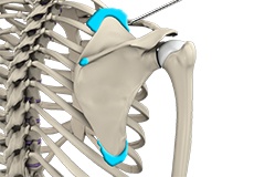 Arthroscopic Scapulothoracic Bursectomy