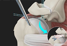 Arthroscopic Superior Capsular Reconstruction (SCR)