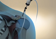 Benefits of Arthroscopic Surgery