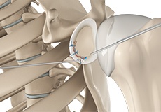 Bony Instability Reconstruction of the Shoulder