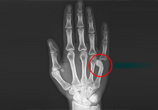 Boxer's Fracture