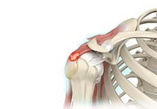 Calcification Tendinitis