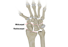 Carpal Instability