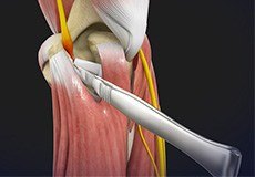 Cubital Tunnel Release (Medial Epicondylectomy)