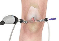 Diagnostic Arthroscopy