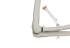 Distal Biceps Avulsion