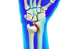 Distal Radioulnar Joint (DRUJ) Arthritis