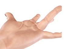 Dupuytren's Contracture