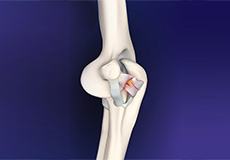 Elbow Ligament Reconstruction