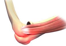 Elbow Sprain