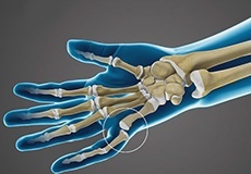 Finger Joint Dislocation and Volar Plate Injury