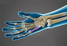 Wrist Fracture