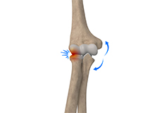 Lateral Impingement of the Elbow