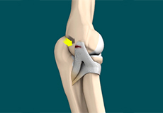 Lateral Ulnar Collateral Ligament Injuries (Elbow)