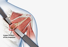 Lower Trapezius Tendon Transfer