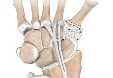 LRTI (Ligament Reconstruction and Tendon Interposition) for Thumb CMC Arthritis