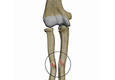 Malunion Surgery (Elbow)