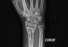ORIF of the Forearm Fractures