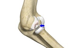 Osteochondritis Dissecans of Elbow