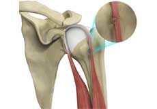 Proximal Biceps Tendon Rupture