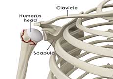 Proximal Humerus Fractures