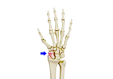 Scaphoid Facture