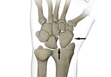 Scapholunate Dissociation
