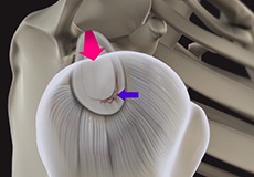 Shoulder Labral Tear with Instability