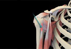 Shoulder Tendonitis