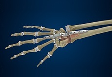 Total Wrist Arthrodesis