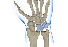 Triquetrolunate Instability