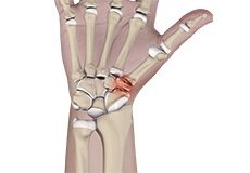 Triscaphoid Joint Arthritis