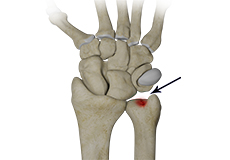 Ulnar Carpal Impaction