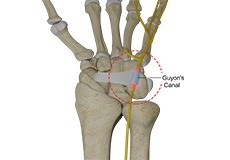 Ulnar Nerve Compression in Guyon's Canal