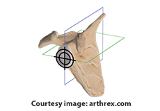 Virtual Implant Positioning by Arthrex