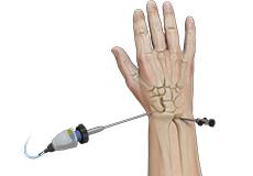 Wrist Arthroscopy