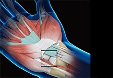 Wrist Ligament Reconstruction