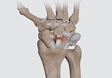 Wrist Ligament Tear and Instability