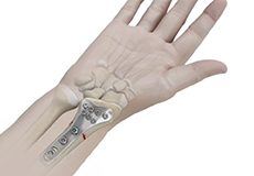 Wrist Open Reduction and Internal Fixation